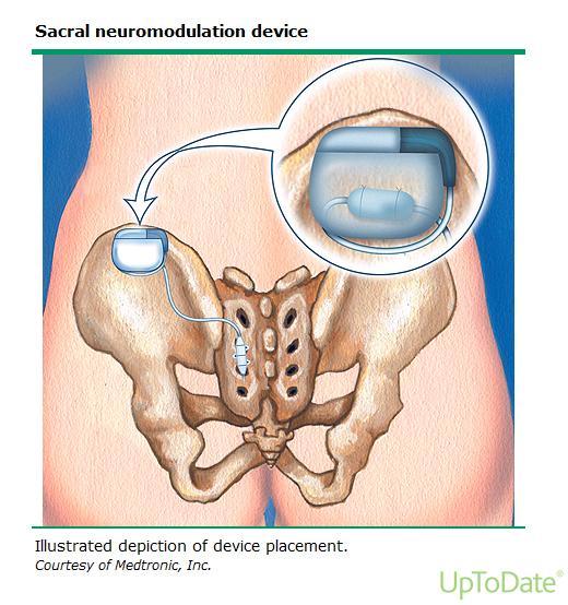 Sacral nerve stimulation Effective treatment for urinary urge incontinence (overactive bladder) A small neurostimulator (about the size of