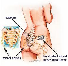 permanent neuro- stimulator implant in upper buttock Expensive, not