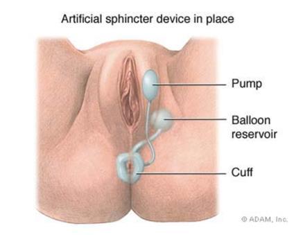anal sphincter repair with