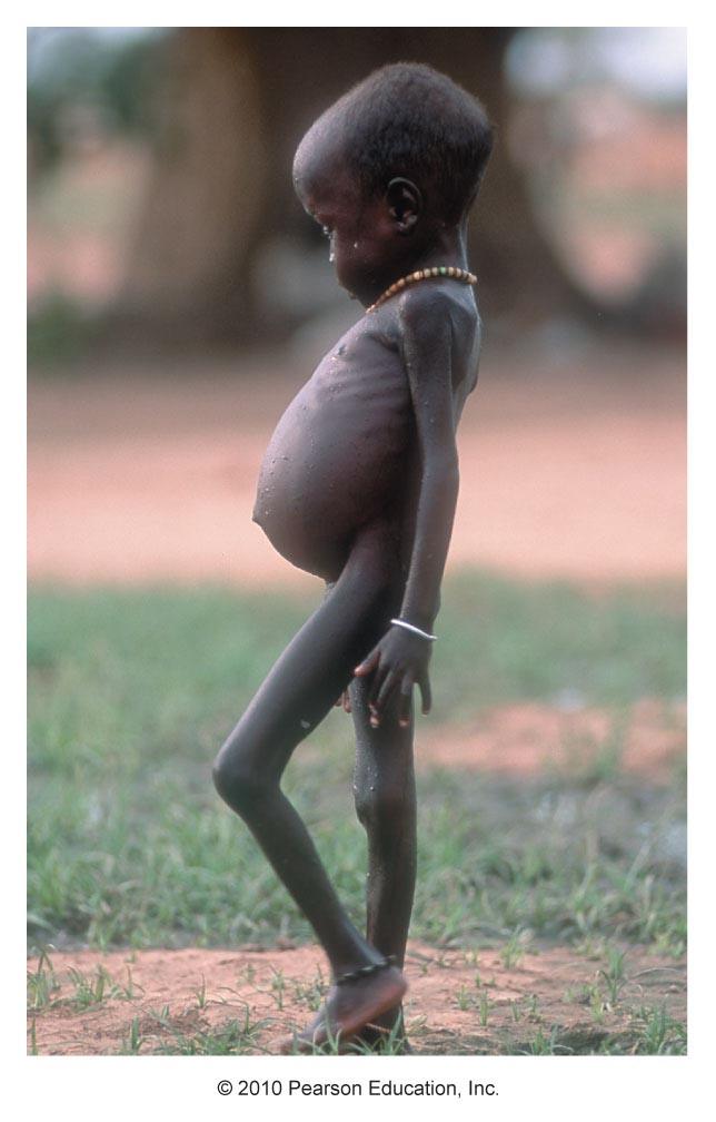 Types of PEM: Marasmic Kwashiorkor Chronic deficiency in kilocalories and protein Have edema in legs and arms Have
