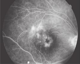 Fig. 4 Right eye of a sarcoidosis patient with macular edema (arrow); before treatment (left) and after treatment with infliximab (right).