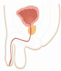 Overview of the Prostate Walnut sized gland at base of the male bladder BLADDER