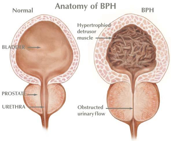 What Happens if BPH is Not Treated?