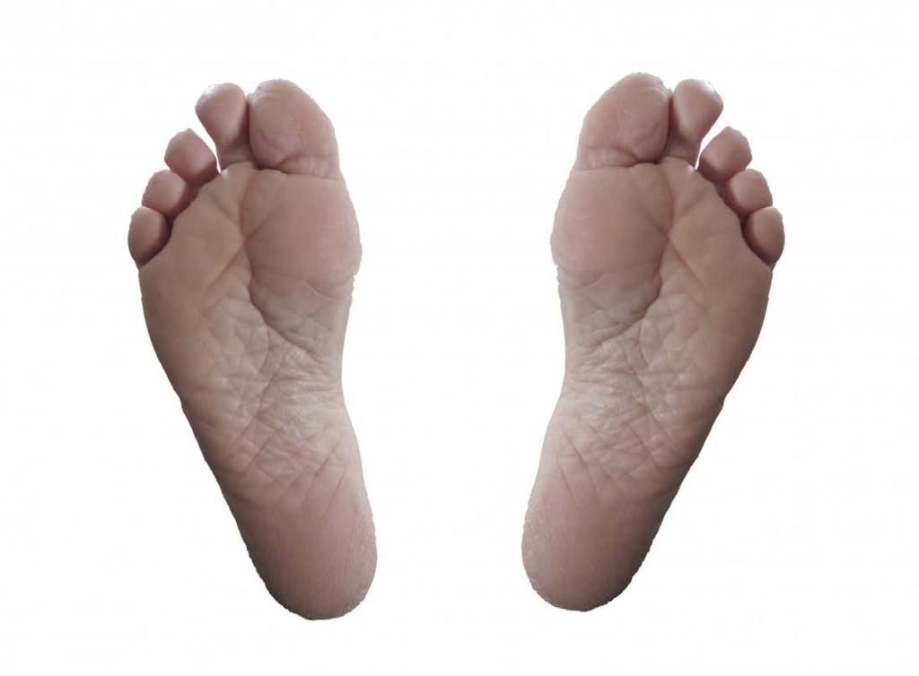 What happens to our feet as we age? Skin Reduction in plantar skin sensitivity.