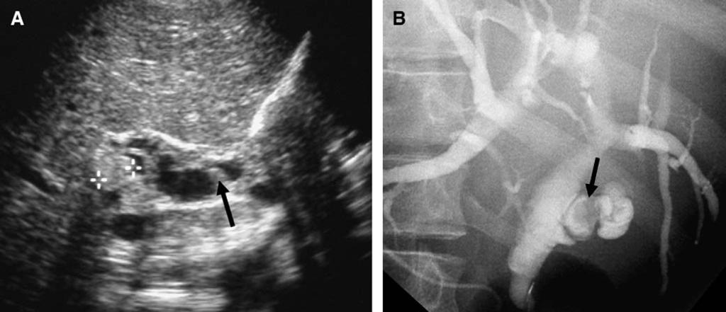 440 Siegel Fig. 15. Cystic duct stone. (A) Longitudinal scan shows a calculus (calipers) in the cystic duct. A second calculus (arrow) is noted in the distal common bile duct, which is dilated.