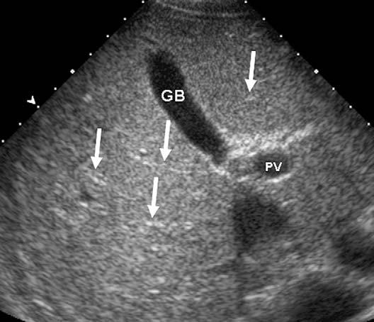 432 Siegel Fig. 1. Normal liver. Transverse sonogram shows homogeneous hepatic parenchyma. The echogenic portal venous vasculature (arrows) is easily seen.