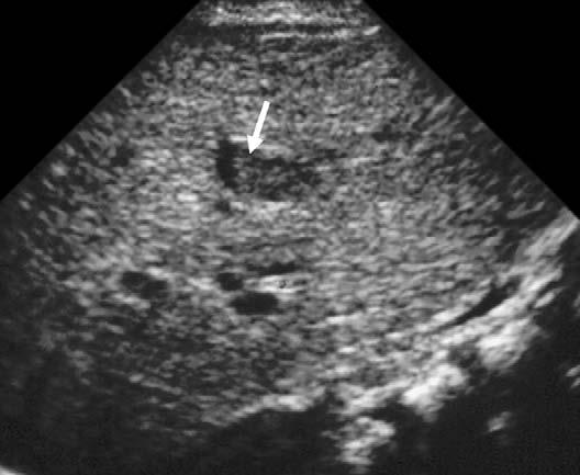 434 Siegel Fig. 4. Neonatal hepatitis. Longitudinal sonogram shows diffusely increased and coarsened echogenicity. The gallbladder is small and filled with sludge (arrow).