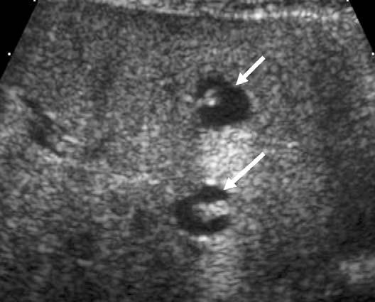 438 Siegel Fig. 9. Caroli disease. Transverse sonogram shows dilated ducts (arrows) that completely envelope the portal radicals. This appearance is termed the central dot sign. Fig. 10.