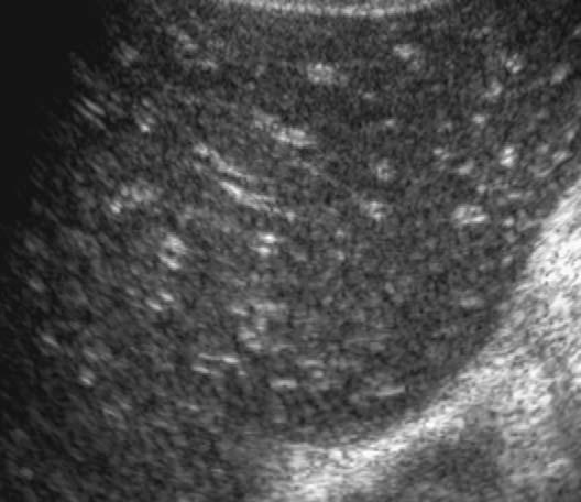 are multiple saccular cystic lesions, some of which may contain echogenic portal veins (the central dot sign) [33].