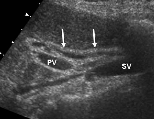 Longitudinal sonogram shows a dilated, thick-walled common bile duct (arrows) (diameter, 9 mm). PV, portal vein; SV, splenic vein.