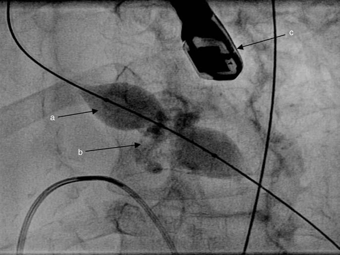 is too large for the currently available TAVI devices). 3 Prior to pre-tavi coronary angioplasty which can often be complex and high risk in the setting of severe AS.