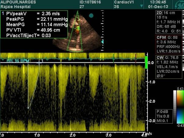 (Right) TTE in the continuous wave Doppler mode shows a nonsignificant residual pulmonary stenosis with a peak pressure gradient of about 20 mm Hg after balloon valvuloplasty.