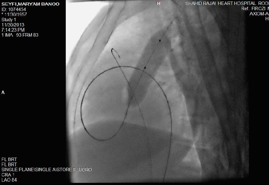 Figure 5. Pulmonary balloon valvotomy with a 26-40 balloon. DISCUSSION PS is a relatively common congenital defect that occurs in approximately 10% of children with congenital heart diseases.