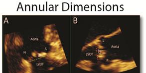 Underestimation of LVOT Diameter by 2D Echocardiography in a Patient