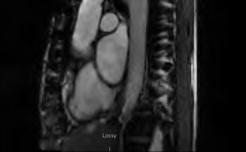 Cardiac MRI Aortic Graft ISCHEMIC MITRAL REGURGITATION Normal Mitral Valve Dal-Bianco J Cardiol Clin 31 (2013) 151 164 Mitral Fibroelastoma Ischemic MR The main mechanism of ischemic