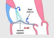 leaflet bend by papillary muscle displacement and leaflet