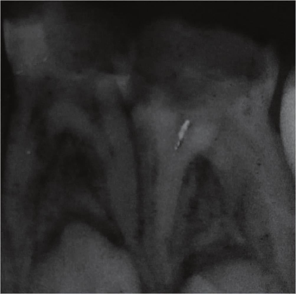 2 Case Reports in Dentistry Figure 1: Preoperative radiograph showing advanced dental caries in left mandibular first and second molars.