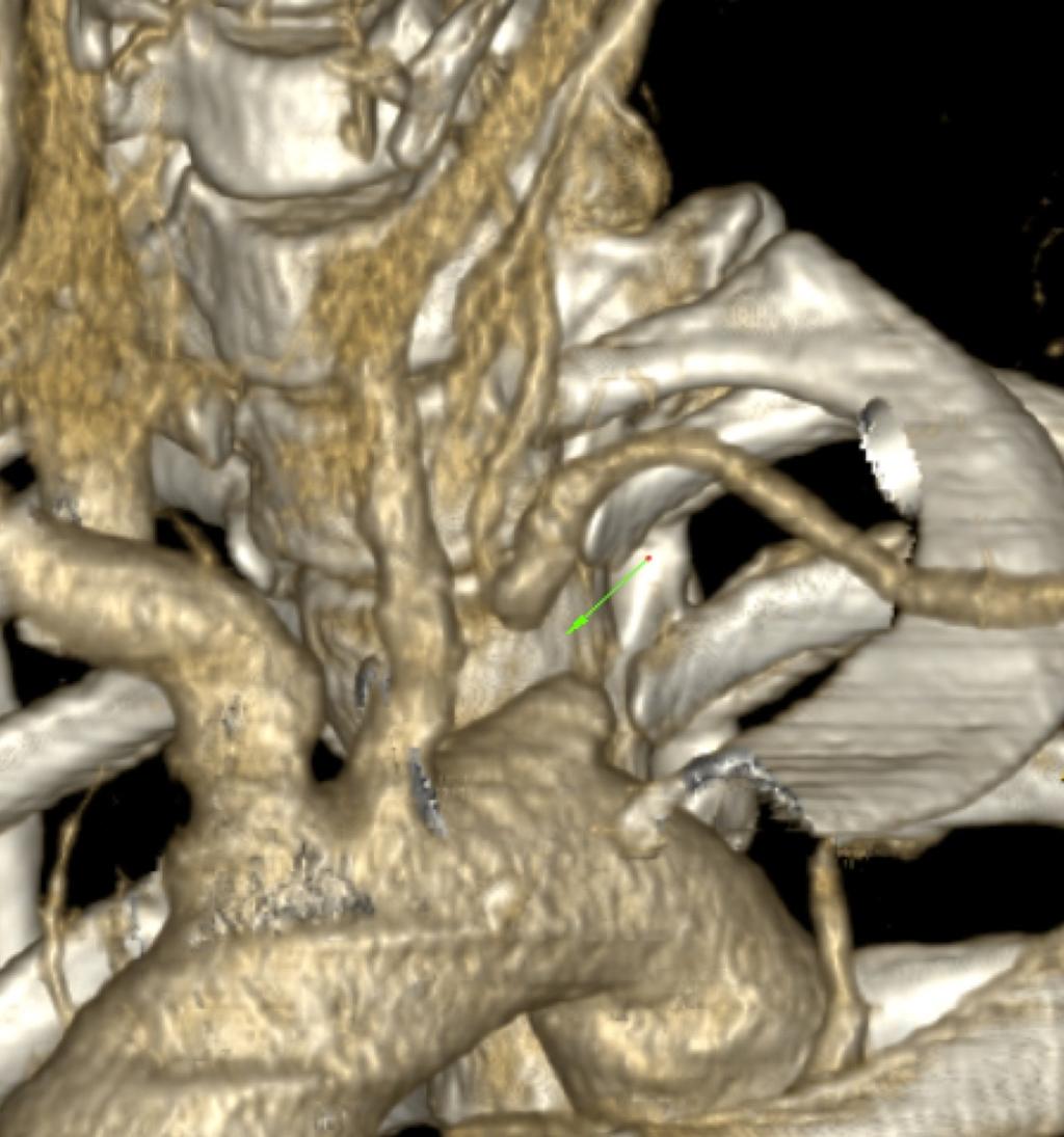 Fig. 4: Volume rendering technique of aortic arch shows interruption of the