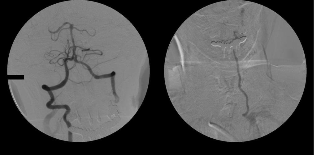 Fig. 7: Same patient showing retrograde filling of left vertebral artery