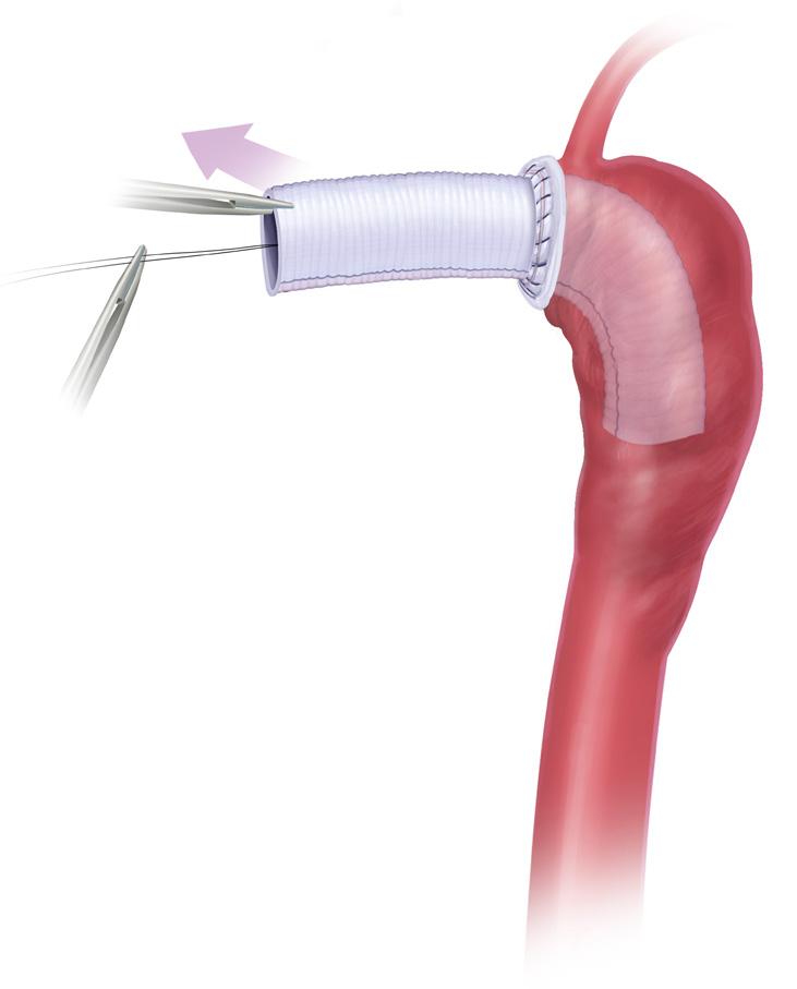 An anastomosis is performed between the aortic tissue and the full thickness of the invaginated graft (two layers) with running suture (Figure 8).