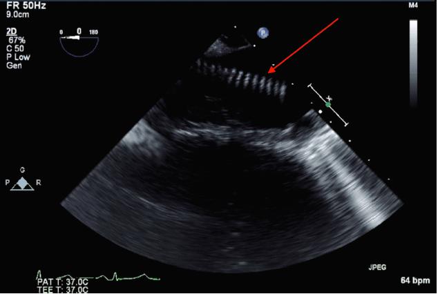Annals of cardiothoracic surgery, Vol 6, No 6 November 2017 717 The diaphragm is incised circumferentially to protect the phrenic nerve and to preserve 2 3 cm of diaphragmatic tissue peripherally for