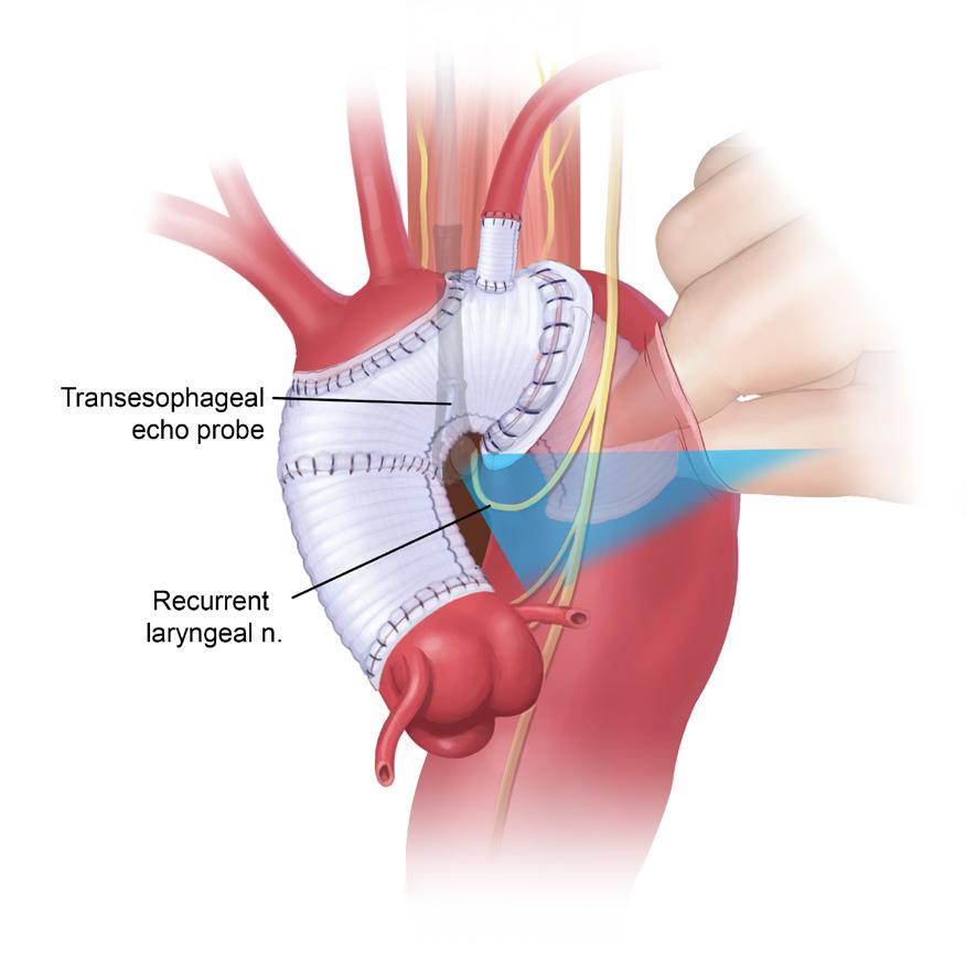 A retroperitoneal approach is used for exposure of the abdominal aorta with medial visceral rotation of the peritoneal structures for better exposure.