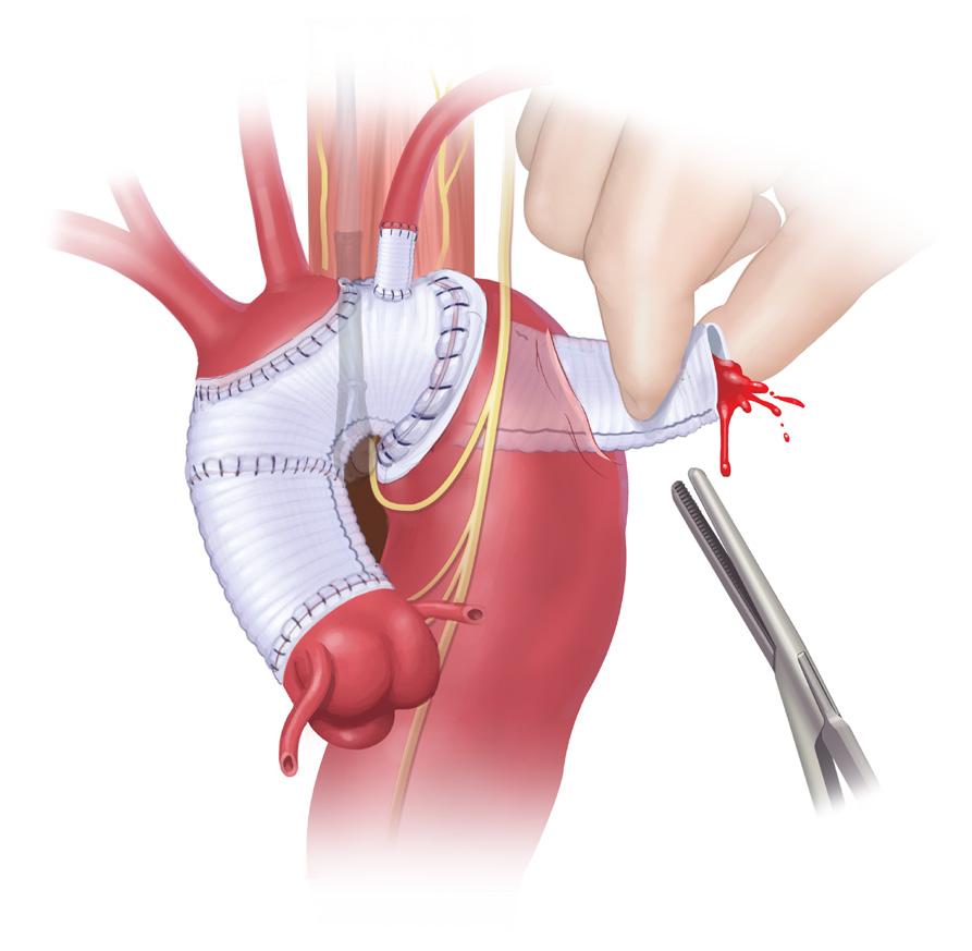 strain with improvement in the ability of the patient to tolerate the aortic clamping.