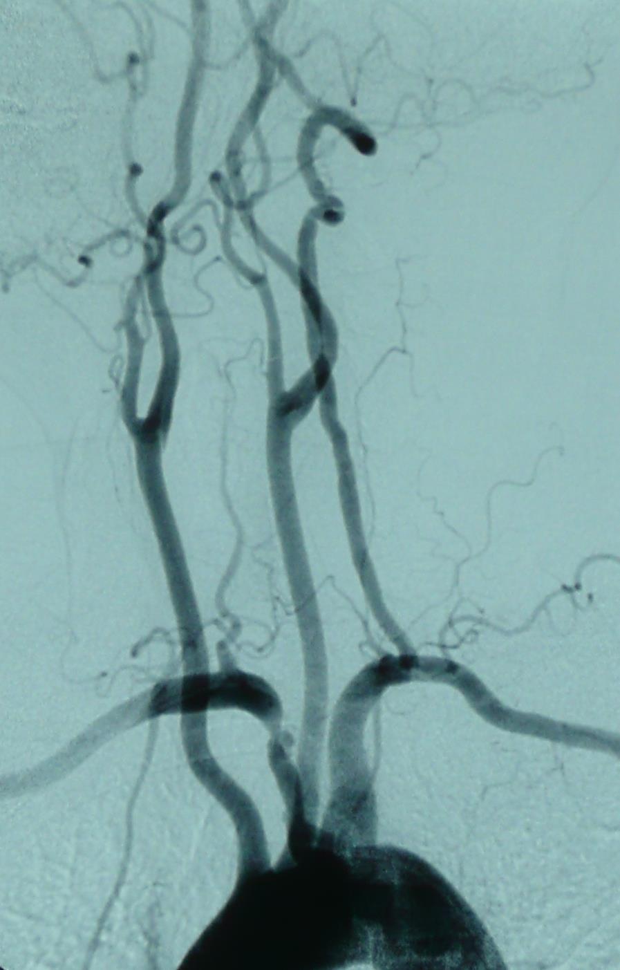 Anatomical Variant Arteria Lusoria