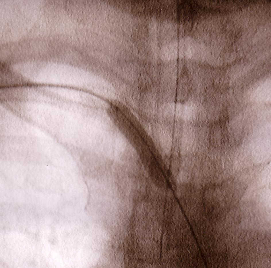 Primary Stenting