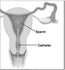 Assisted Reproductive Technologies (ART) Performed by