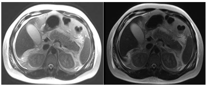 Repeat imaging was obtained on day 3 due to concern of pancreatic necrosis and/or hemorrhage.