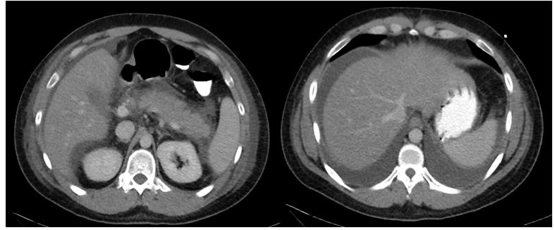 Fig. 3). Conservative management was continued. Fig. 1. Day 1 hospitalization. CT abdomen/pelvis w/contrast showing acute pancreatitis Fig. 2. Day 2 hospitalization.