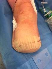 Our patients are the worst They have Critical limb ischemia in combination with diabetic ulcer (neuroischemic) 50%