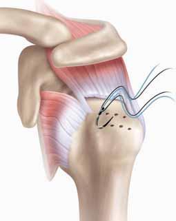 Releases of the rotator cuff tendon should be performed on the superior and posterior capsule off the labrum, and the supraspinatus