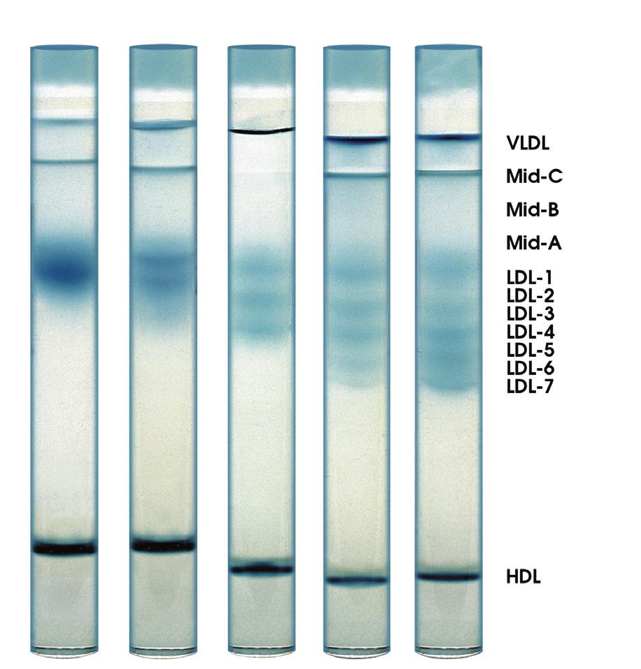 Procedural Note: Distortion of the separating gel surface and the VLDL band may occur during electrophoresis.