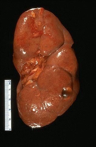Normal Human Kidney Fetal lobules Renal cyst 9 Fetal lobules normally, but not