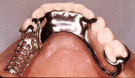 LINGUAL PLATE Used when fgm to floor of mouth is less than 7mm, or when anteriors are mobile and their longevity is questionable.