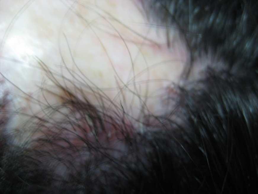 Scalp Biopsy and Diagnosis of Common Hair Loss Problems http://dx.doi.org/10.5772/55025 21 Figure 8. LPP of the scalp.