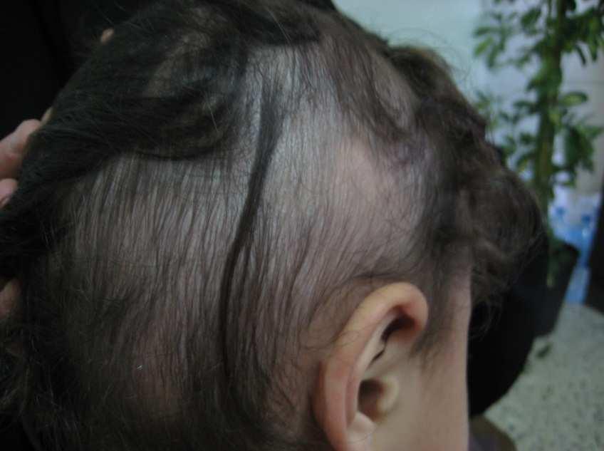 Scalp Biopsy and Diagnosis of Common Hair Loss Problems http://dx.doi.org/10.5772/55025 23 topical minoxidil, irritants (anthralin or topical coal tar), and topical immunotherapy.