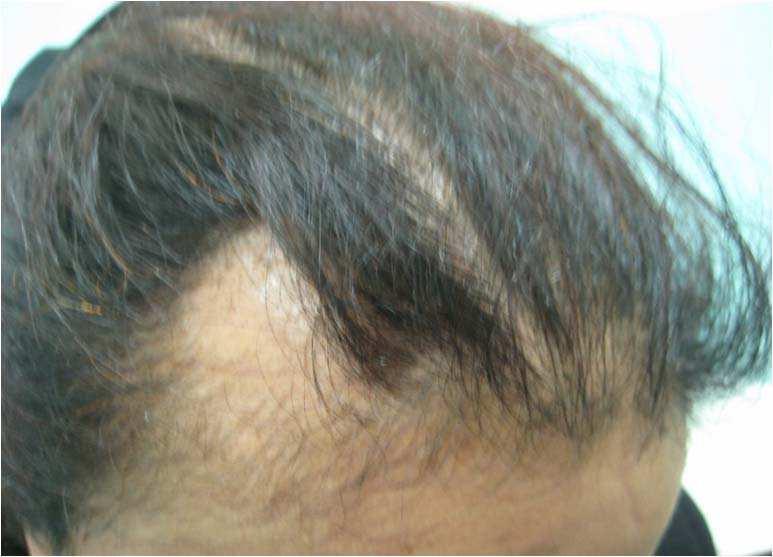 14 Skin Biopsy - Diagnosis and Treatment To establish the cause of the hair loss, one requires a history to identify known triggers, scalp examination, biochemical investigations and in many cases