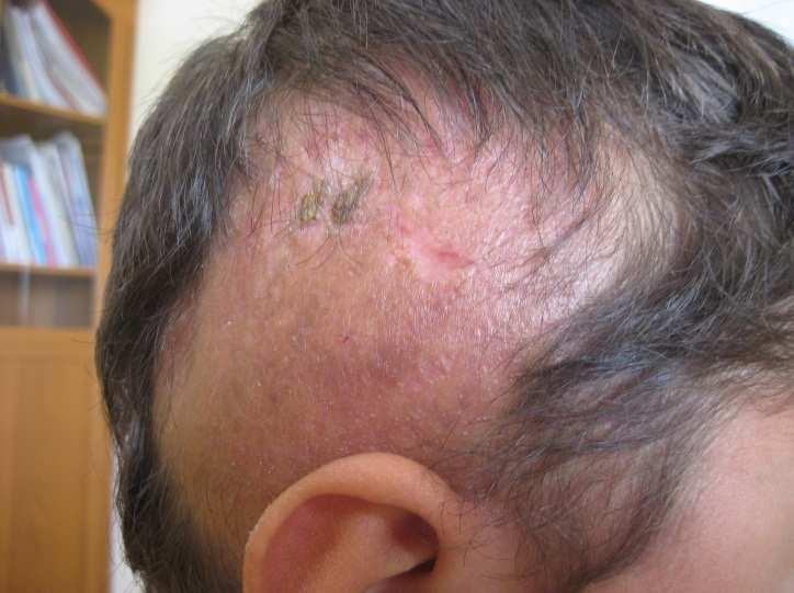 Scalp Biopsy and Diagnosis of Common Hair Loss Problems http://dx.doi.org/10.