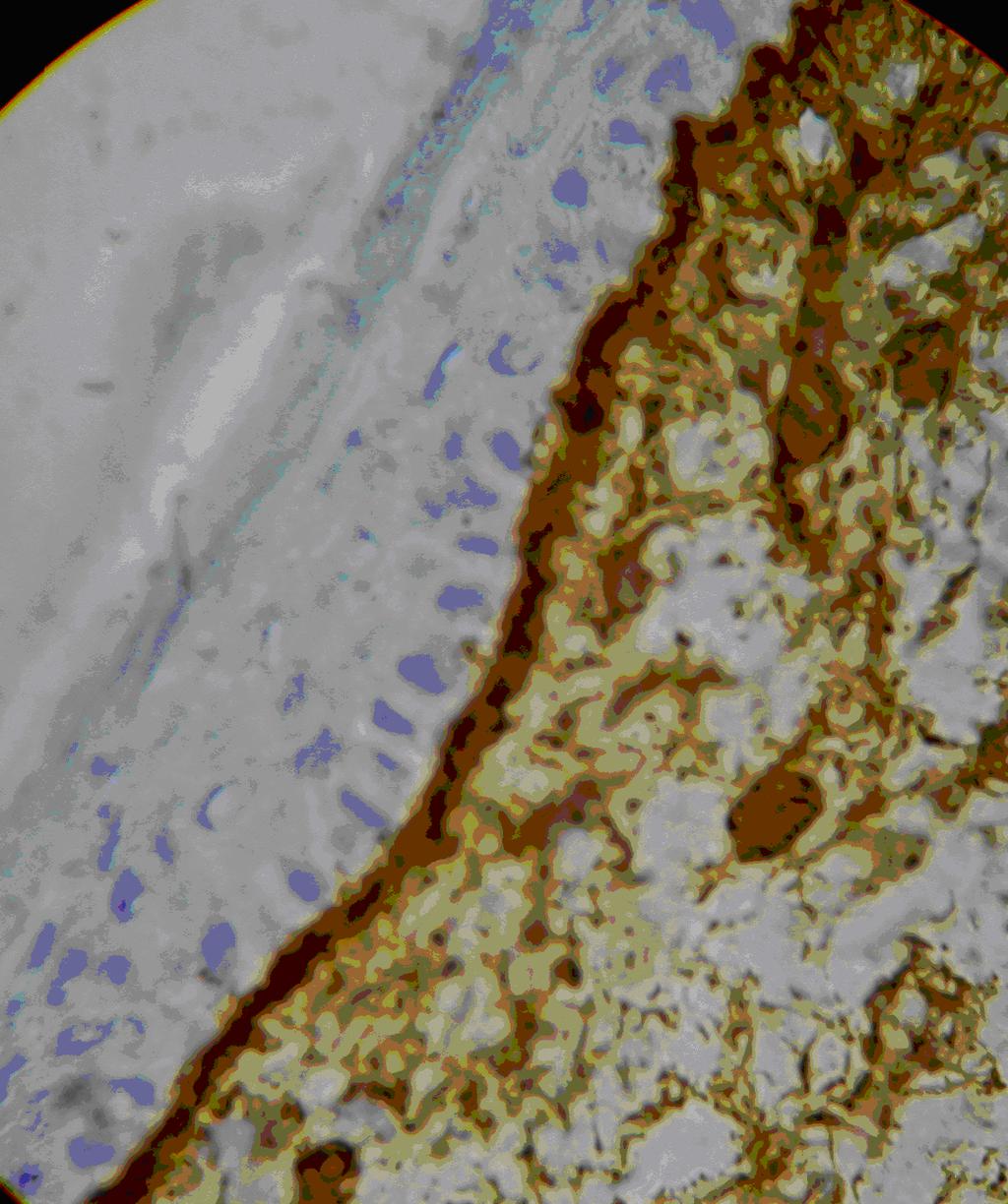 20 Skin Biopsy - Diagnosis and Treatment collagen component antigens in the BMZ with gross thickening and protrusion into the dermis in active DLE lesions (Fig 7). Figure 7.