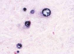 Histochemical Stains Used to Detect Fungi Periodic acid Schiff (PAS) Highlights Fungal