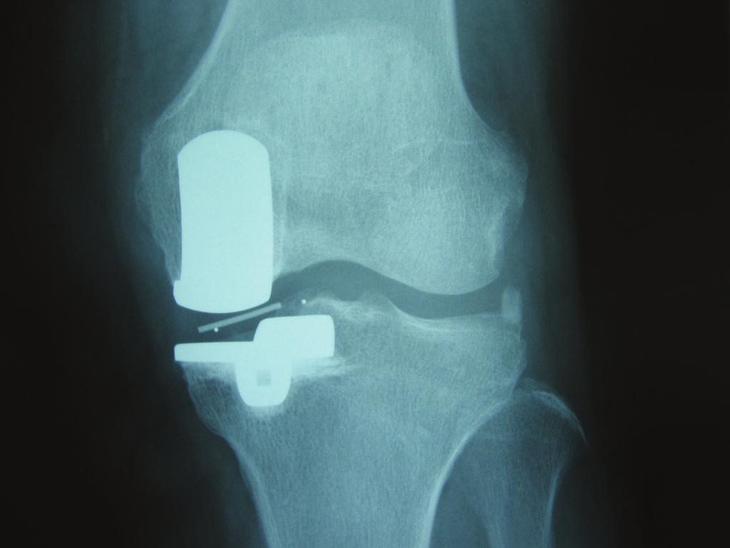 2 Case Reports in Orthopedics Figure 1: Anteropoasterior weigh-bearing radiograph and lateral radiograph in knee flexion showing the abnormal position of marker in meniscal bearing (case 1).