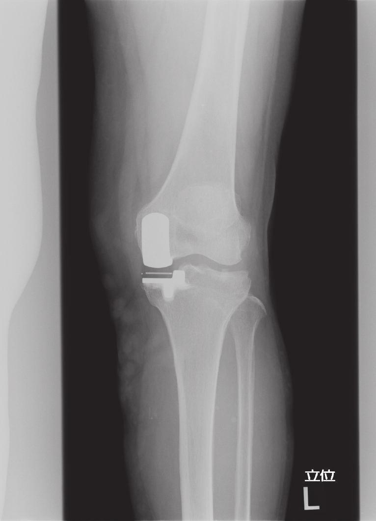 4 Case Reports in Orthopedics Figure 5: Malrotation of femoral rotation (simulation on Athena).