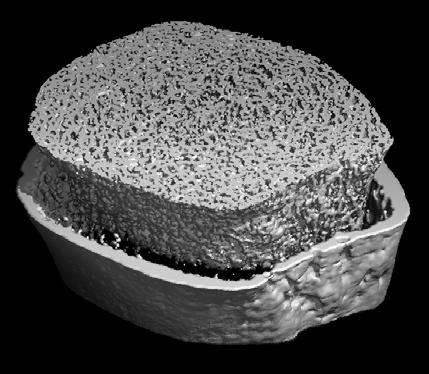 High Resolution Peripheral Quantitative Computed Tomography (HR-pQCT) Non-invasive technology, voxel size 61-82 µm Allows for in vivo assessment at distal radius and tibia of Bone size Volumetric