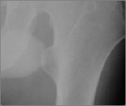 fracture 10. Tibial plateau fractures 5.