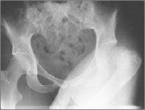 9. Dislocated hip with ipsilateral femoral fracture 10.