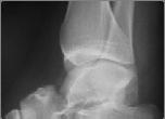 Inadequate Study Need two or more views to assess for fracture or dislocation Need