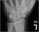 Fracture Patterns 27M Alignment Rules These are helpful at various sites ACJ Lisfranc joint